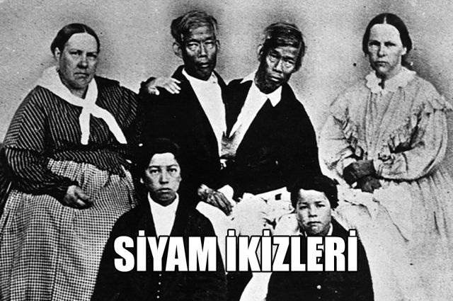 SİYAM İKİZLERİ